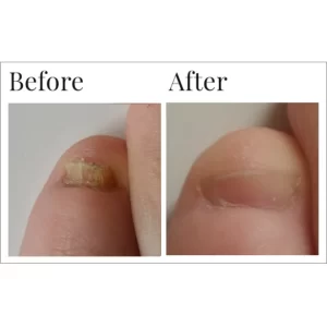 Dr-canuso-fungal-nail-eraser-liquid-topical-anti-fungal-treatment-1-case-8-units-x-0-5-oz-15-ml-each-by-dr-canuso-ff-609101-2_1160x_crop_center
